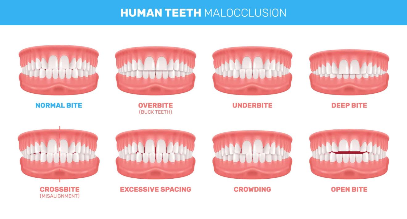 2112.i309.035.S.m012.c13.human teeth malocclusion realistic set scaled f00960dc