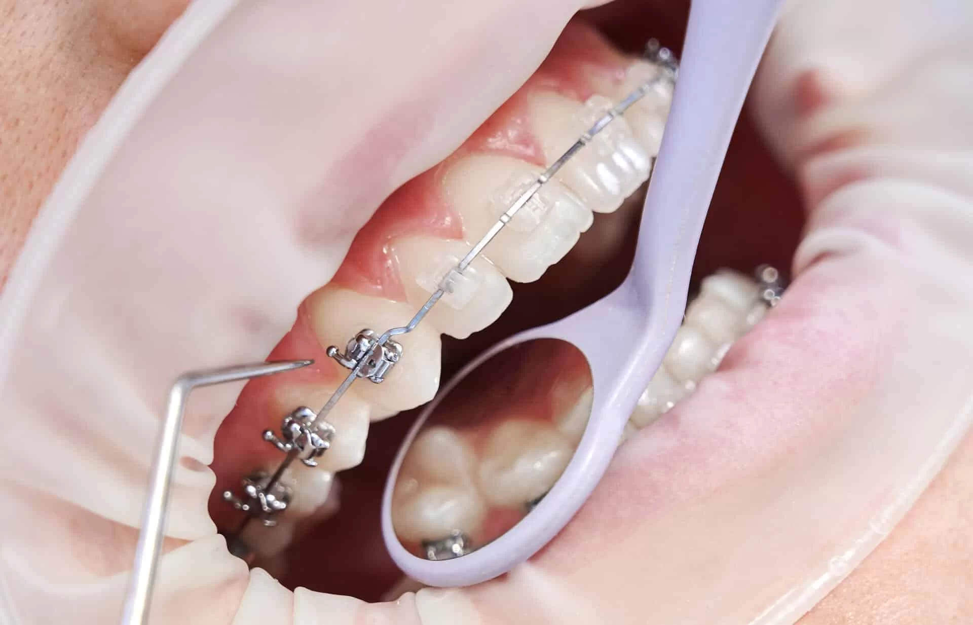 Teeth Braces Types: 5 Modern Options to Compare 2 Traditional metal braces being checked during an orthodontic appointment